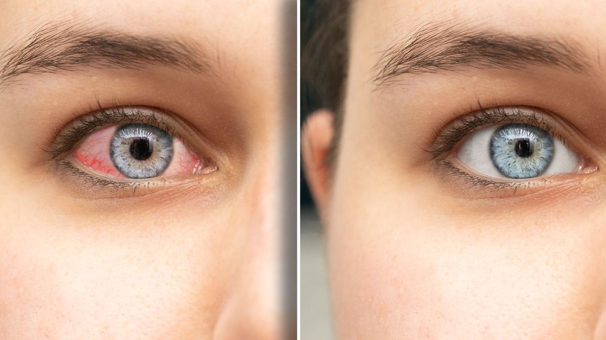 Optometristka varuje před očními kapkami s bělicími účinky